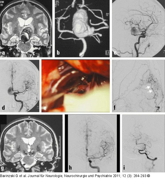 Aneurysma per magna