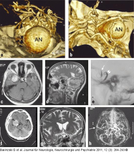 Riesenaneurysma