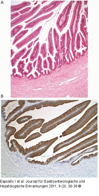 Neoplasie