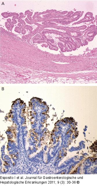 Neoplasie