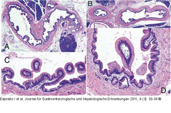 Neoplasie
