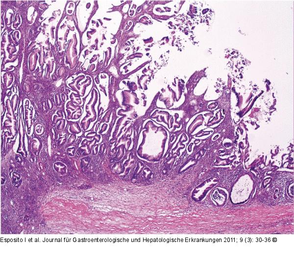 Neoplasie