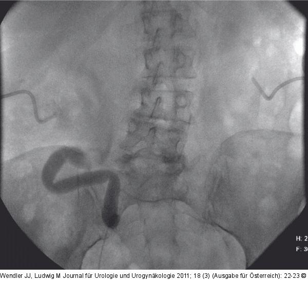 Ureteropyelographie