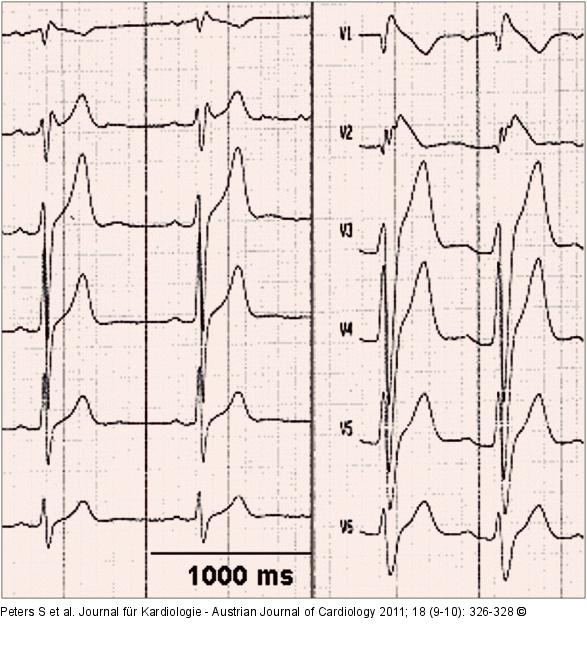 ECG leads