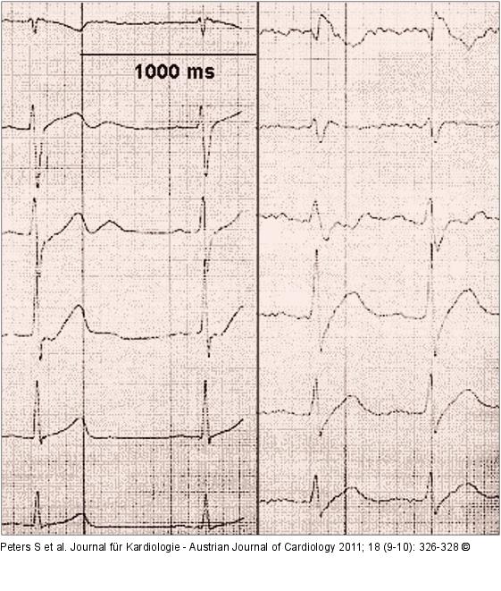 ECG leads