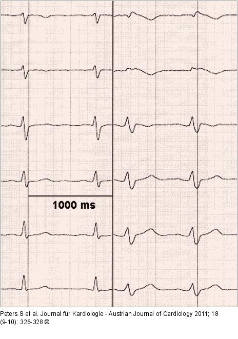 ECG leads