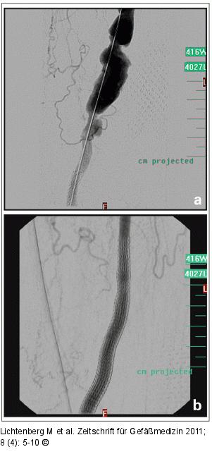 Femoropoplitealvenenbypass