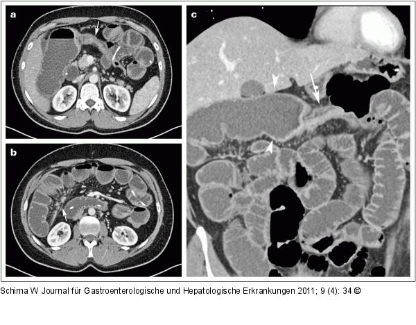 Morbus Crohn