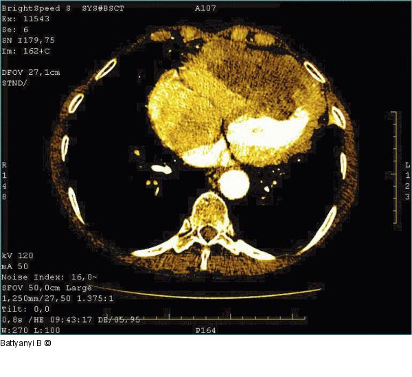 Thorax-CT