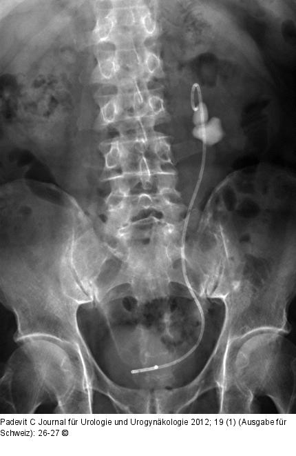 Abdomen