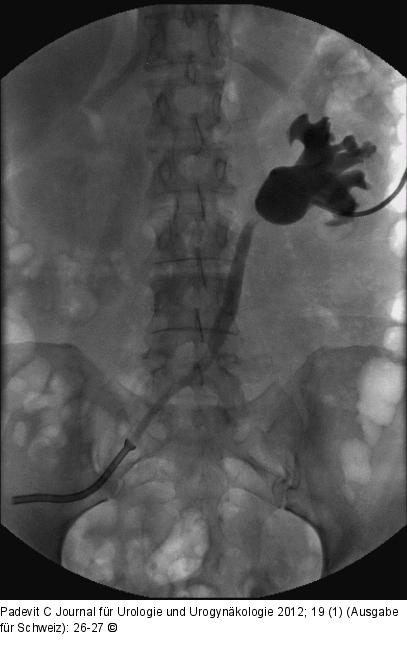 Nephrostomie 