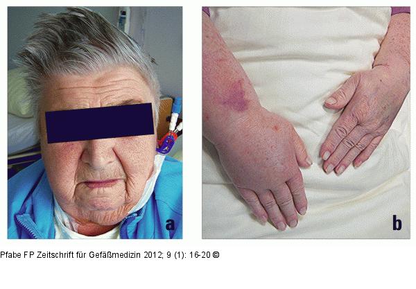 Gesichts- und Handschwellung