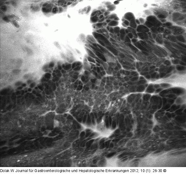 Barrett-Adenokarzinom