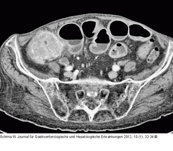 Abdomen - Tumor