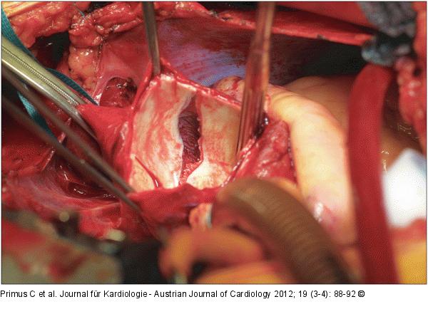 Intraoperativer Situs