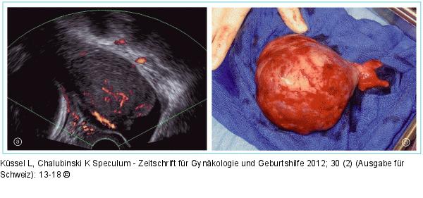 Gorlin-Goltz-Syndrom