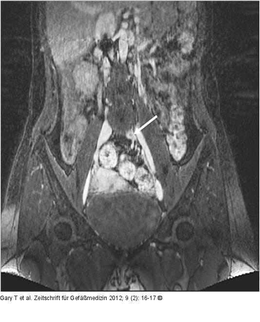Antikoagulation - Restthrombose