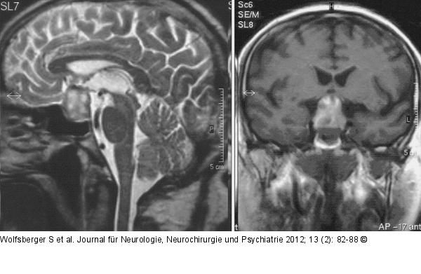 Hypophysenapoplexie