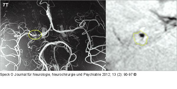ToF-Angiogramm