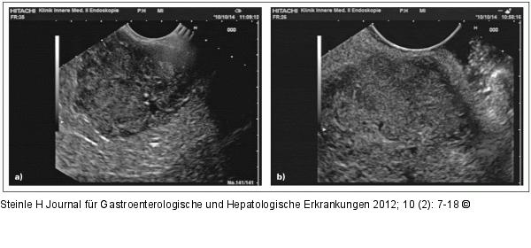 Tumor - Magen