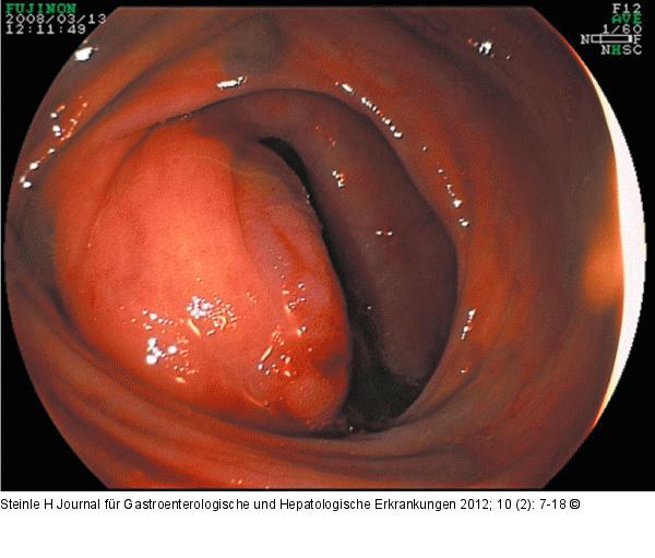 Tumor - Ileum