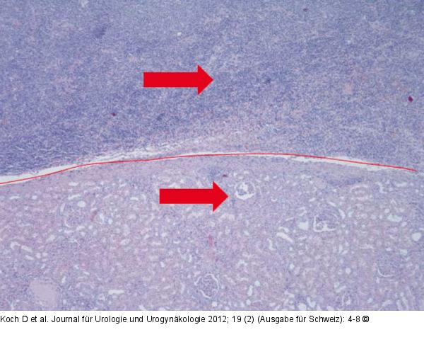 Lymphom