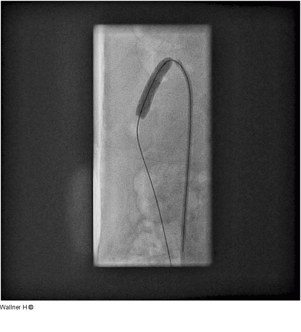 Stentangioplastie