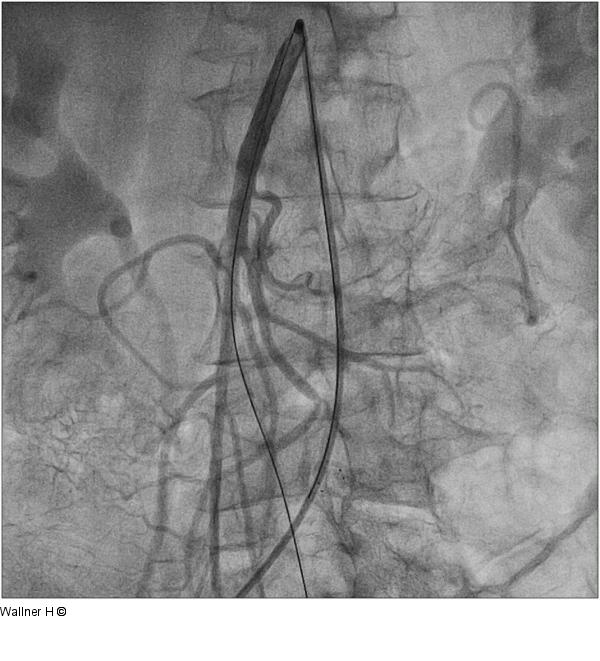 Aorta abdominalis
