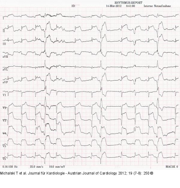 STEMI-Hebung