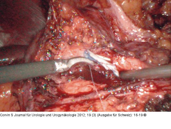 Transplantat