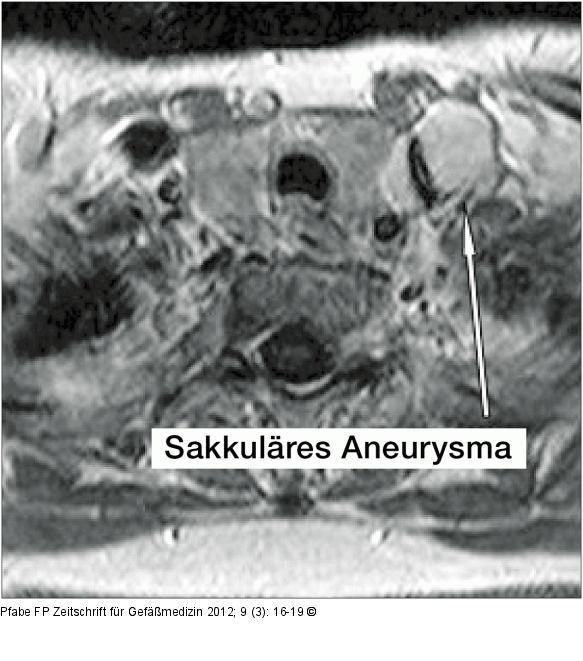 Aneurysma