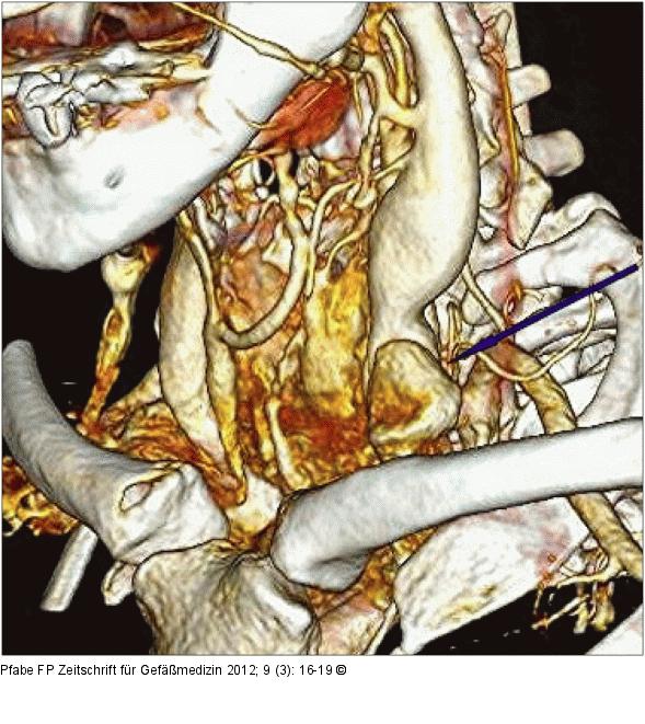 Sakkulres Aneurysma