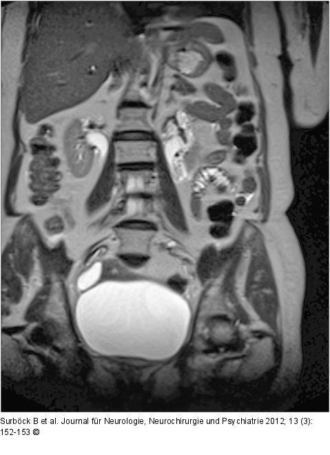 Arteria-spinalis-anterior-Syndrom