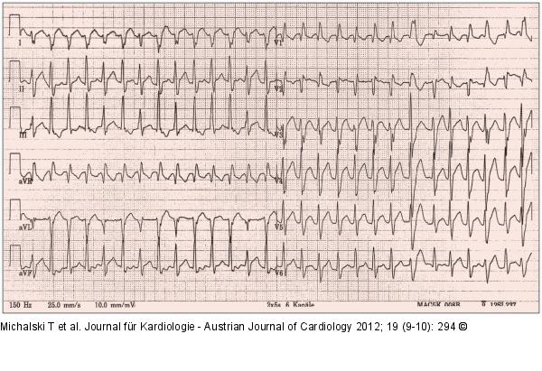 EKG