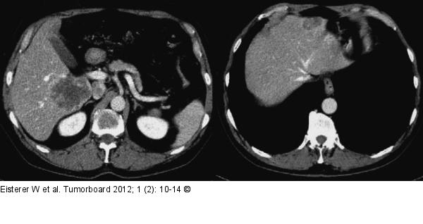 Primrtumor - Leber