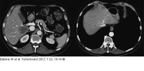 Remission - Leber