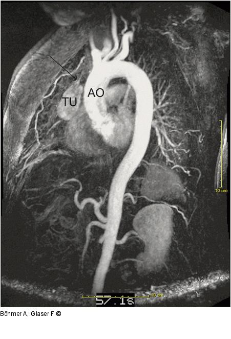 Tumor - Kontrastierung