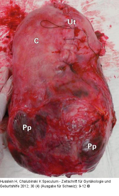 Uterusprparat