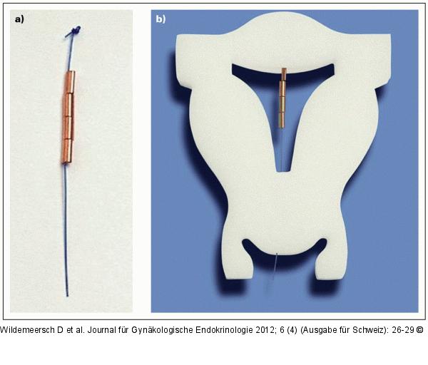 Gynefix(R)