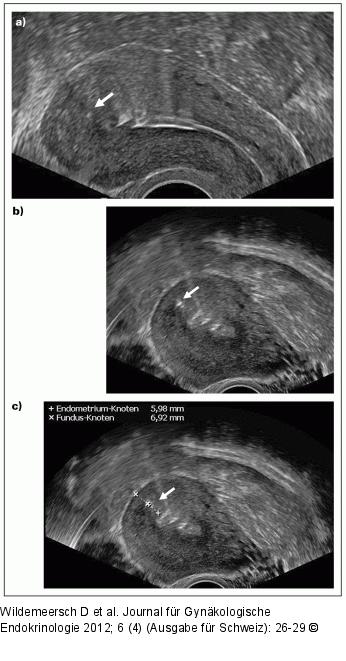 Gynefix(R) - Verankerung