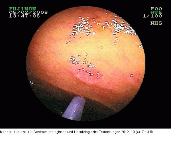 Angiodysplasie