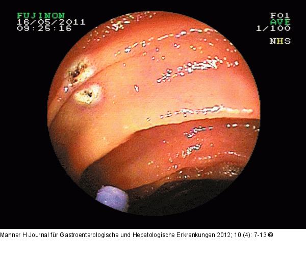Angiodysplasie