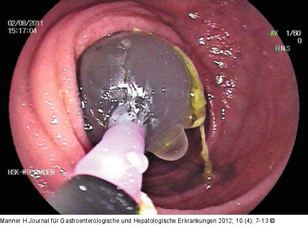 M. Crohn