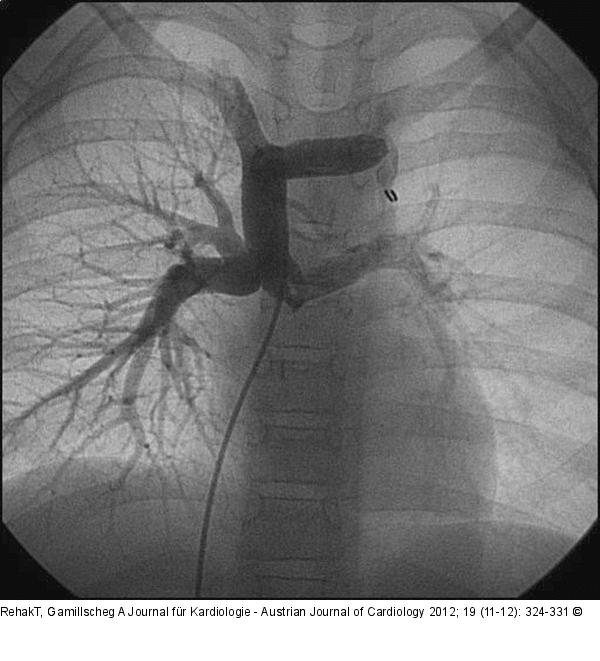 Vena cava superior