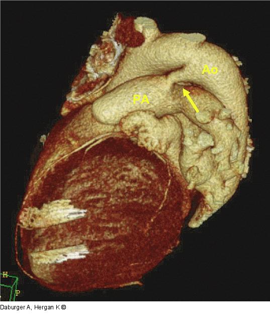 CT-PDA