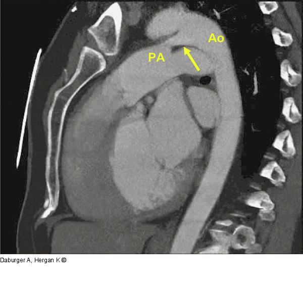 CT-PDA