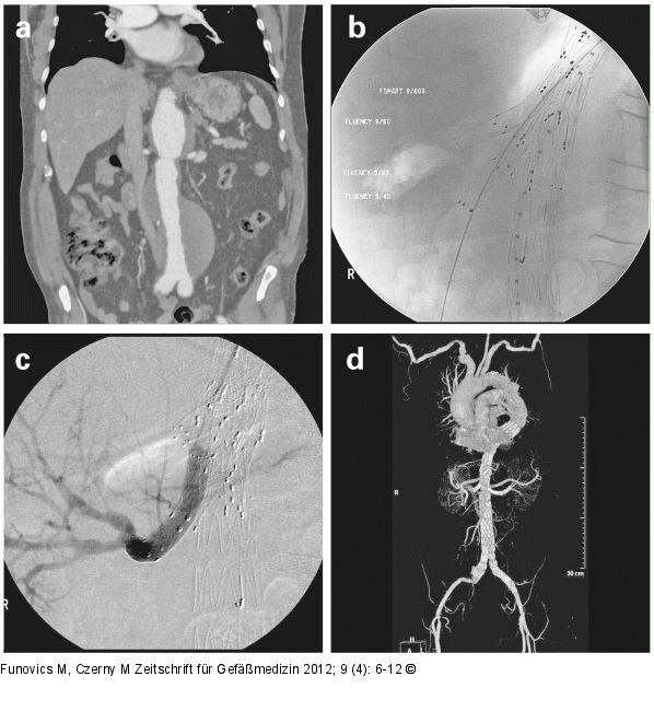 Endoprothese