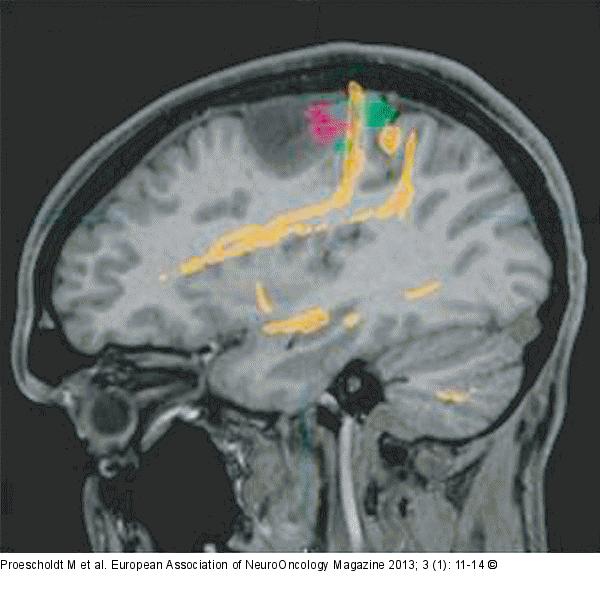 Glioma - Surgery