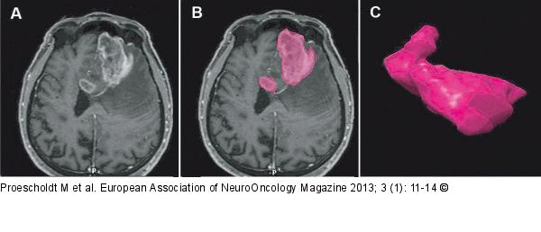Glioma - Surgery