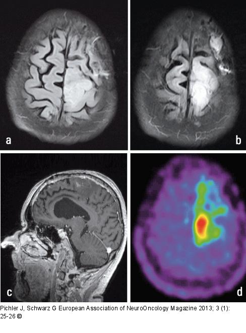 Tumour